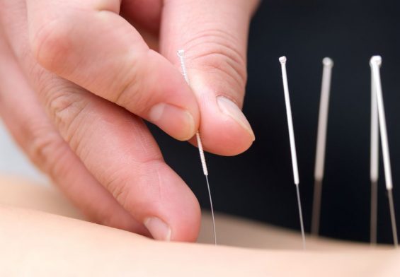 Acupuncture Work